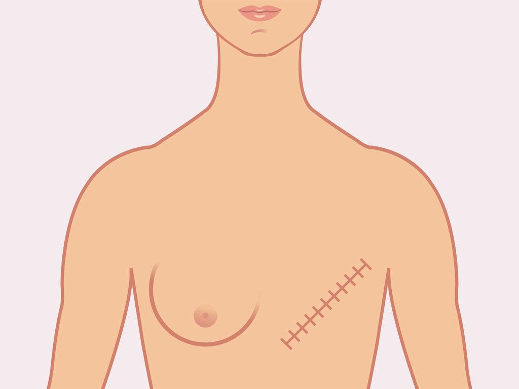 Mastectomy scar graphic