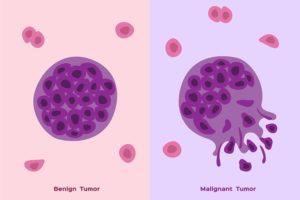 Types of Tumors graphic