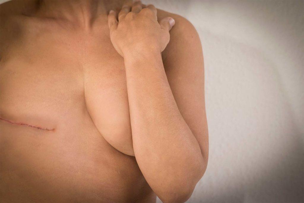 Mastectomy scar