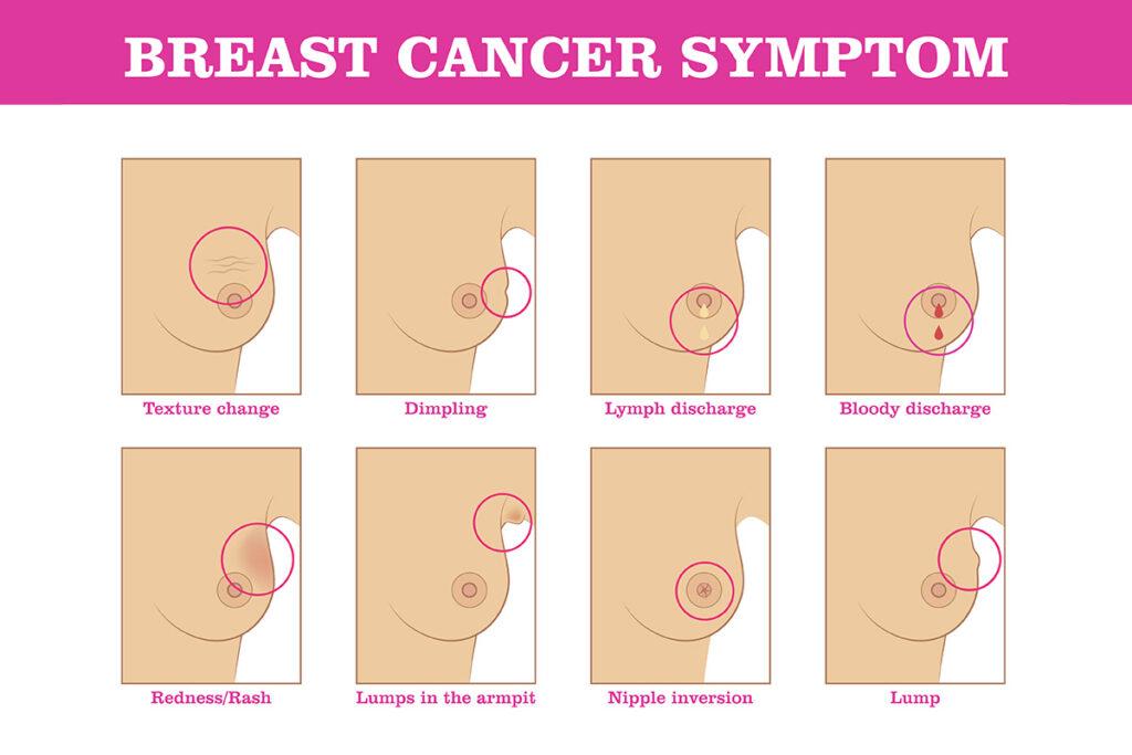Breast Cancer Symptoms graphic