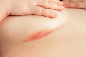 Under Breast Rashes - Q4